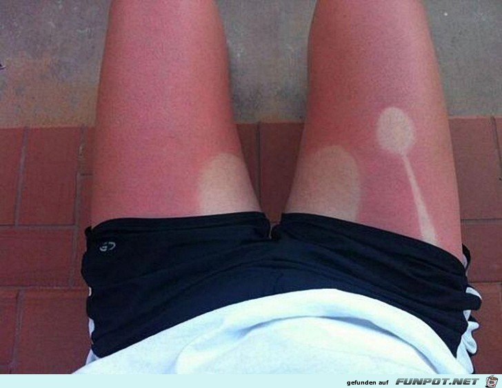 Sonnenbrand Sonnenbrand