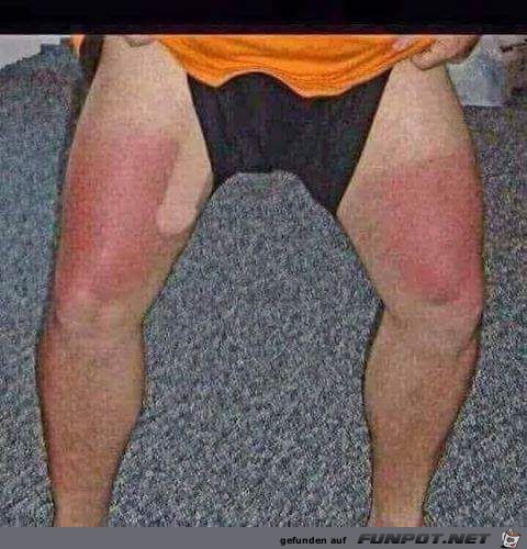Sonnenbrand bekommen Sonnenbrand bekommen
