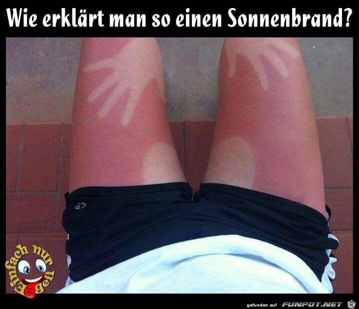 Sonnenbrand Sonnenbrand