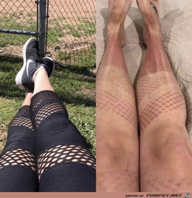 Sonnenbrand Sonnenbrand