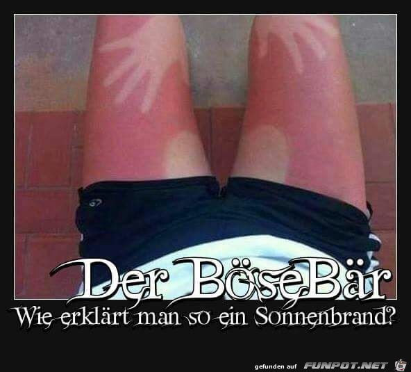 Sonnenbrand Sonnenbrand