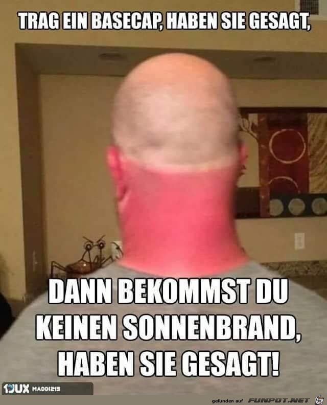 Sonnenbrand Sonnenbrand
