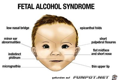 Fetales Alkoholsyndrom Fetales Alkoholsyndrom
