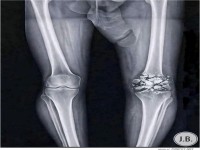 Knie ist Matsch