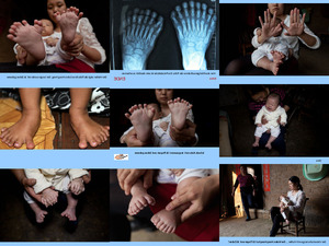China Baby mit 15 Finger und 16 Zehen